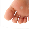 Corns and Callouses