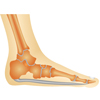 Flat Feet &ndash; Over Pronation