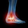Heel Pain